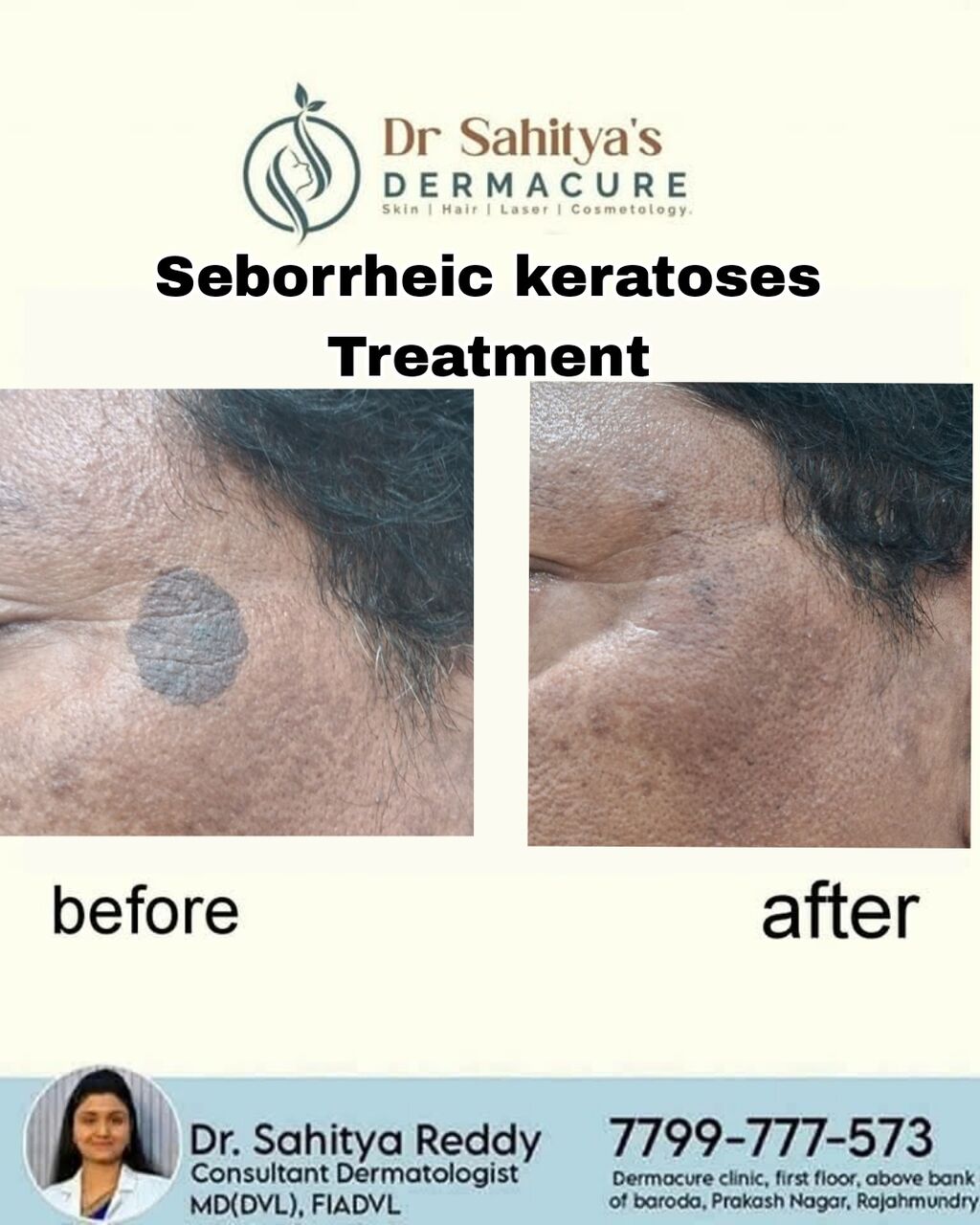 Kurnool, Health, Best Seborrheic Keratosis Treatment In Rajahmundry - Rajahmundry