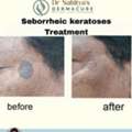 Best Seborrheic Keratosis Treatment In Rajahmundry - Rajahmundry