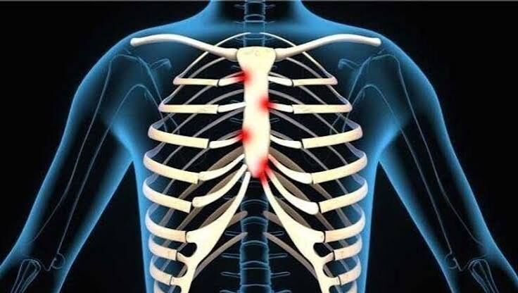 Gurgaon, Businesses For Sale, Costochondritis Physiotherapy Treatment In Gurgaon | Expert Physiotherapy For Chest Wall P