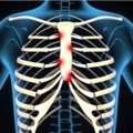 Costochondritis Physiotherapy Treatment In Gurgaon | Expert Physiotherapy For Chest Wall P