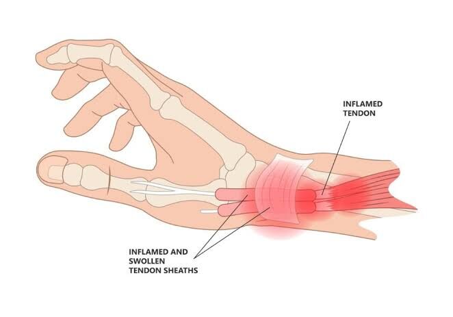 Gurgaon, Businesses For Sale, De Quervain Tenosynovitis Treatment In Gurgaon | Expert Physiotherapy For Wrist & Thumb Pa