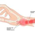 De Quervain Tenosynovitis Treatment In Gurgaon | Expert Physiotherapy For Wrist & Thumb Pa