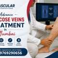 Regain Comfort With Modern Varicose Vein Treatment