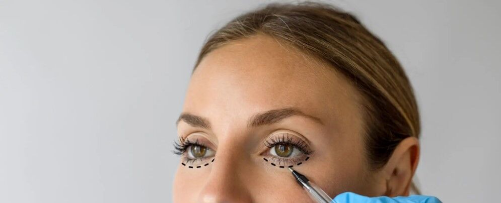 Mumbai, Health, Upper & Lower Blepharoplasty In Mumbai &ndash; Expert Care