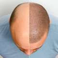 Hair Transplant Price In Bhopal | Bhopal Hair Clinic