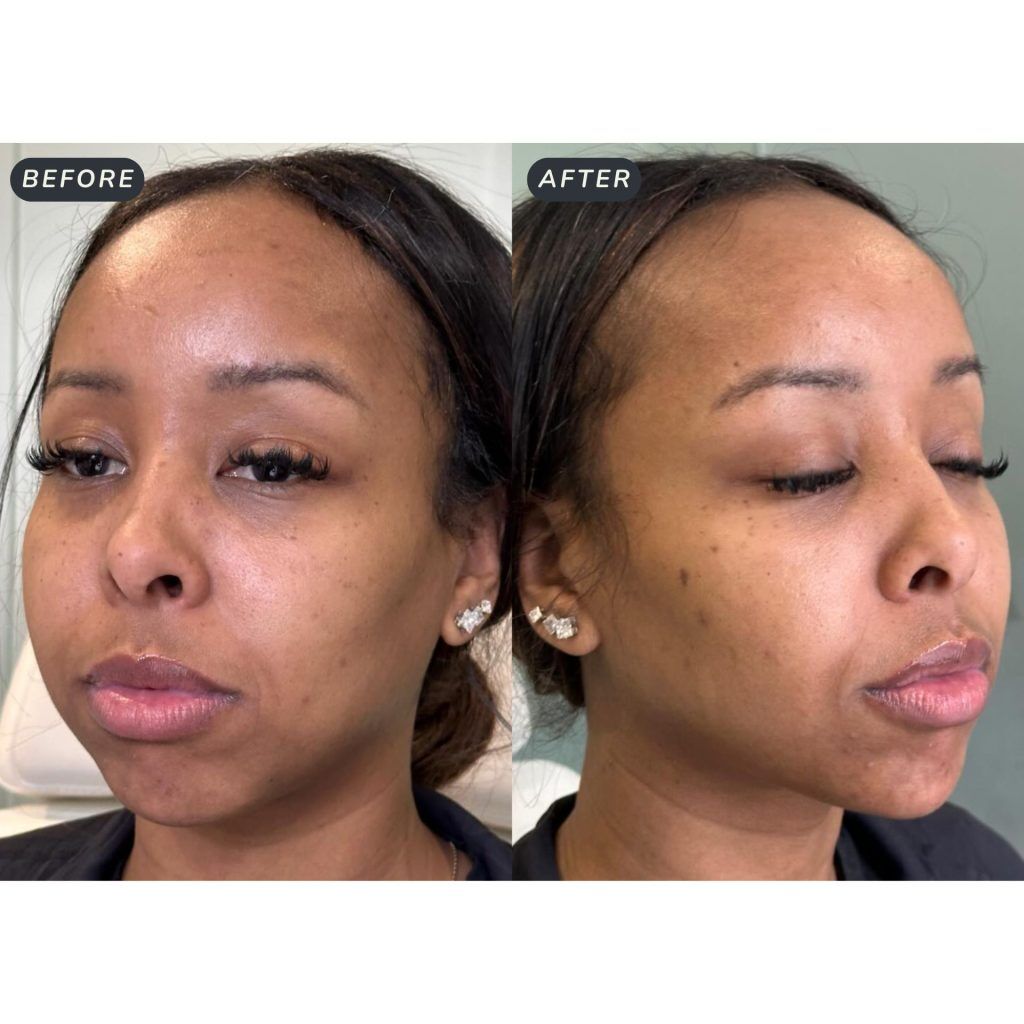 Toronto, Health, Double Chin Removal Toronto Treatment