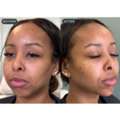 Double Chin Removal Toronto Treatment
