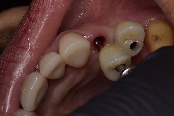 Mexico City, Dental, Count On The Best Dentist In Mexico To Get Your Ideal Smile