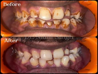 Kolkata, General, Professional Teeth Cleaning At The Aesthetic House &ndash; Dental Clinic In Rajarhat
