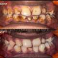 Professional Teeth Cleaning At The Aesthetic House &ndash; Dental Clinic In Rajarhat