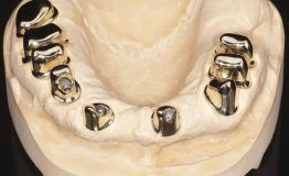 Shenzhen, Dental, Restorations With High-Quality Dental Attachments Today