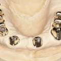 Restorations With High-Quality Dental Attachments Today