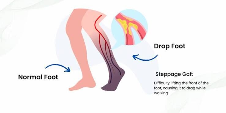 Gurgaon, Businesses For Sale, Foot Drop Treatment In Gurgaon | Expert Physiotherapy For Faster Recovery