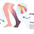 Foot Drop Treatment In Gurgaon | Expert Physiotherapy For Faster Recovery