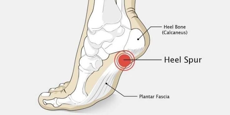 Gurgaon, Businesses For Sale, Calcaneal Spur Treatment In Gurgaon | Expert Heel Pain Physiotherapy
