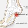 Calcaneal Spur Treatment In Gurgaon | Expert Heel Pain Physiotherapy
