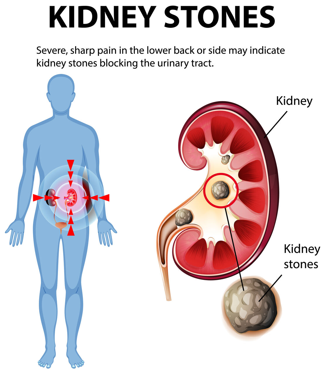 Mumbai, Health, Ayurvedic Treatment For Kidney Stones A Natural Approach To Kidney Health
