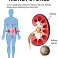 Ayurvedic Treatment For Kidney Stones A Natural Approach To Kidney Health