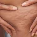 Cellulite Reduction
