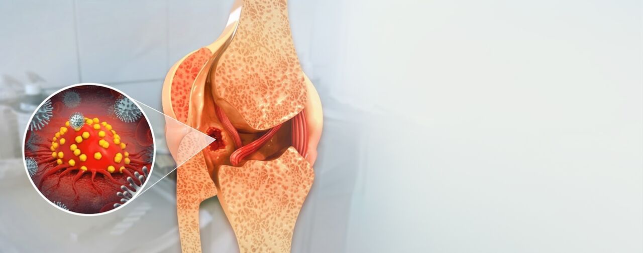 New Delhi, Health, Bone Cancer Hospital In Delhi