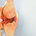 Bone Cancer Hospital In Delhi
