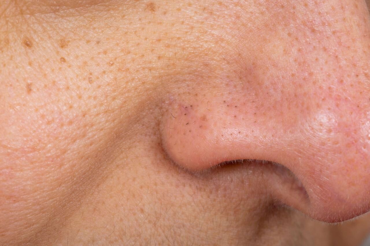 Noida, Health, Open Pores Treatment In Noida &ndash; Smoother Skin Is Possible