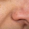 Open Pores Treatment In Noida &ndash; Smoother Skin Is Possible