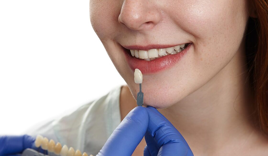 Melbourne, Dental, Book Composite Veneers In Melbourne For A New Look