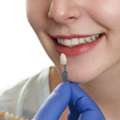 Book Composite Veneers In Melbourne For A New Look
