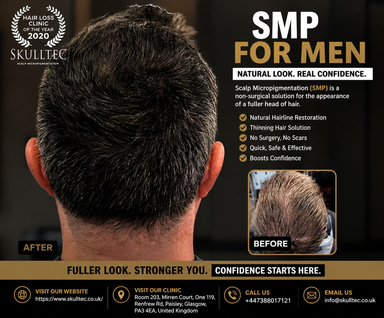 London, Health, SMP For Men | Natural Scalp Micropigmentation Solutions