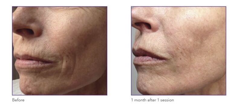 Toronto, Beautician, Best RF Microneedling Treatment In Richmond Hill