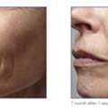 Best RF Microneedling Treatment In Richmond Hill
