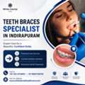 Teeth Braces Specialist In Indirapuram For Perfect Smiles