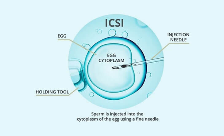 New Delhi, Health, ICSI Treatment In Delhi - Dr Rhythm Gupta