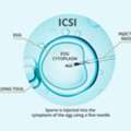 ICSI Treatment In Delhi - Dr Rhythm Gupta