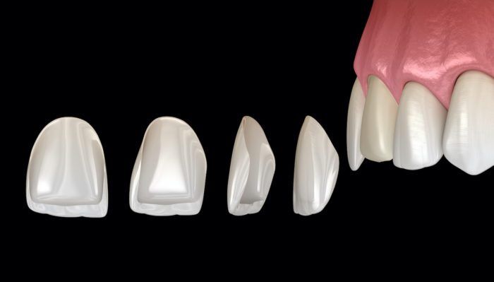 New York, Dental, Porcelain Veneers Ventura &ndash; Transform Your Smile With Confidence