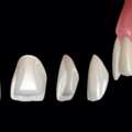 Porcelain Veneers Ventura &ndash; Transform Your Smile With Confidence
