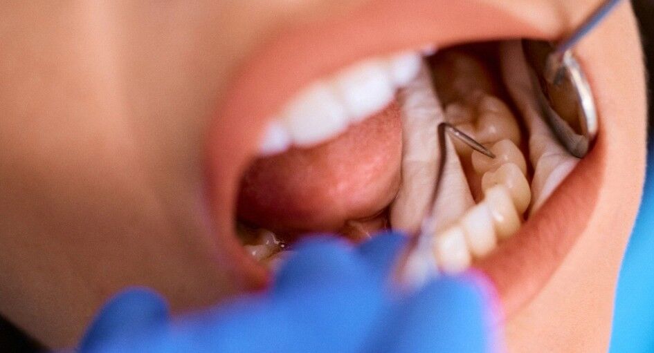 Al Ain, Dental, Dental Filling In Al Ain For Long-Lasting Repair