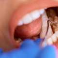 Dental Filling In Al Ain For Long-Lasting Repair