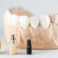Dental Crowns In Al Ain For Long-Lasting Care