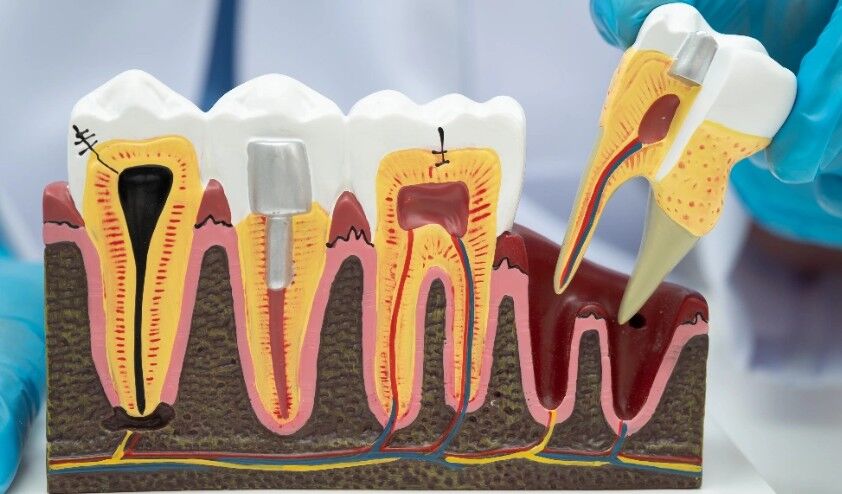 Al Ain, Dental, Root Canal Treatment In Al Ain For Gentle Care