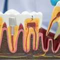 Root Canal Treatment In Al Ain For Gentle Care