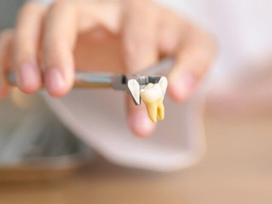 Al Ain, Dental, Tooth Extraction In Al Ain For Expert Relief