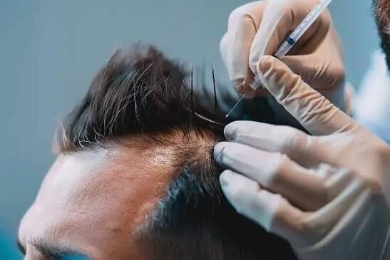 New Delhi, Health, Why Fly To Turkey When World-Class Hair Transplant Is Right Here?