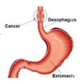 Trusted Esophageal Cancer Specialist In Noida | Dr. Manish Singhal