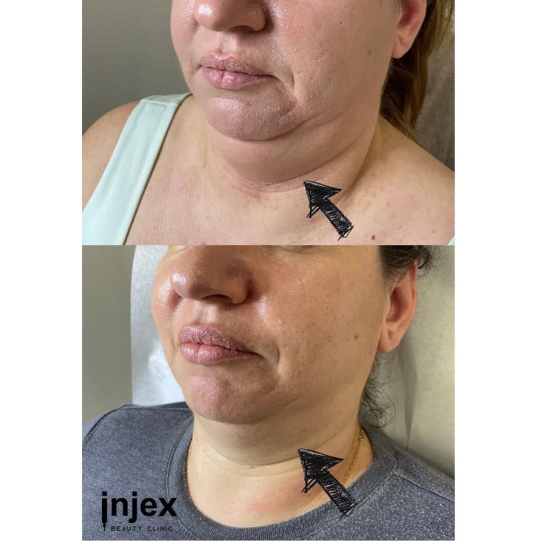 Mississauga, Beautician, Double Chin Fat Dissolving Cost In Toronto | Injex Beauty