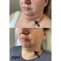 Double Chin Fat Dissolving Cost In Toronto | Injex Beauty