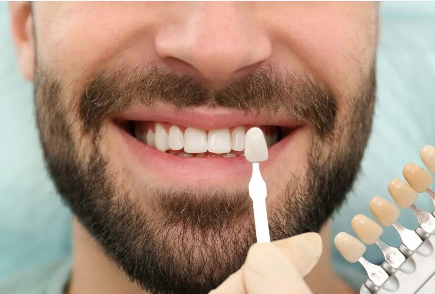 Al Ain, Dental, Dental Veneers In Al Ain