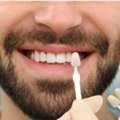 Dental Veneers In Al Ain