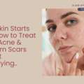 Clear Skin Starts Here: How To Treat Active Acne & Stubborn Scars Without Overpaying